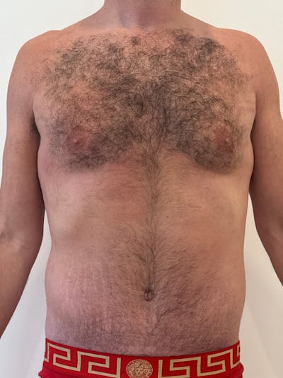 Body Lift Before & After Gallery - Patient 332820 - Image 2