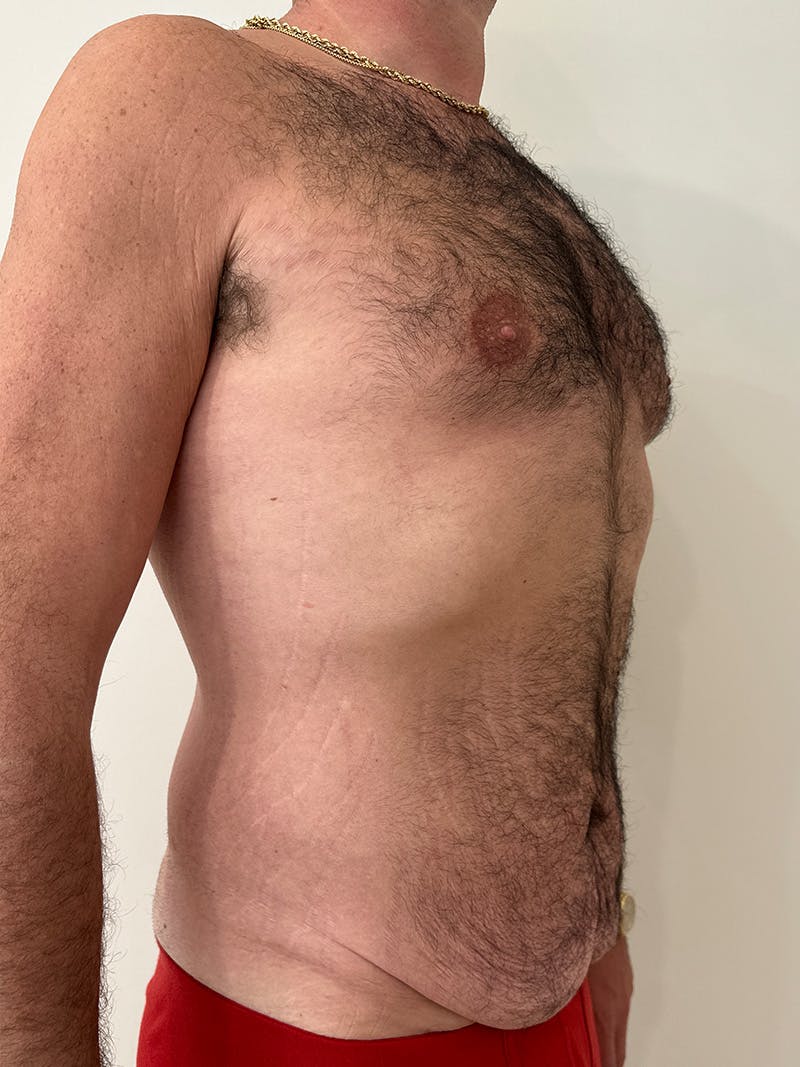 Body Lift Before & After Gallery - Patient 332820 - Image 3
