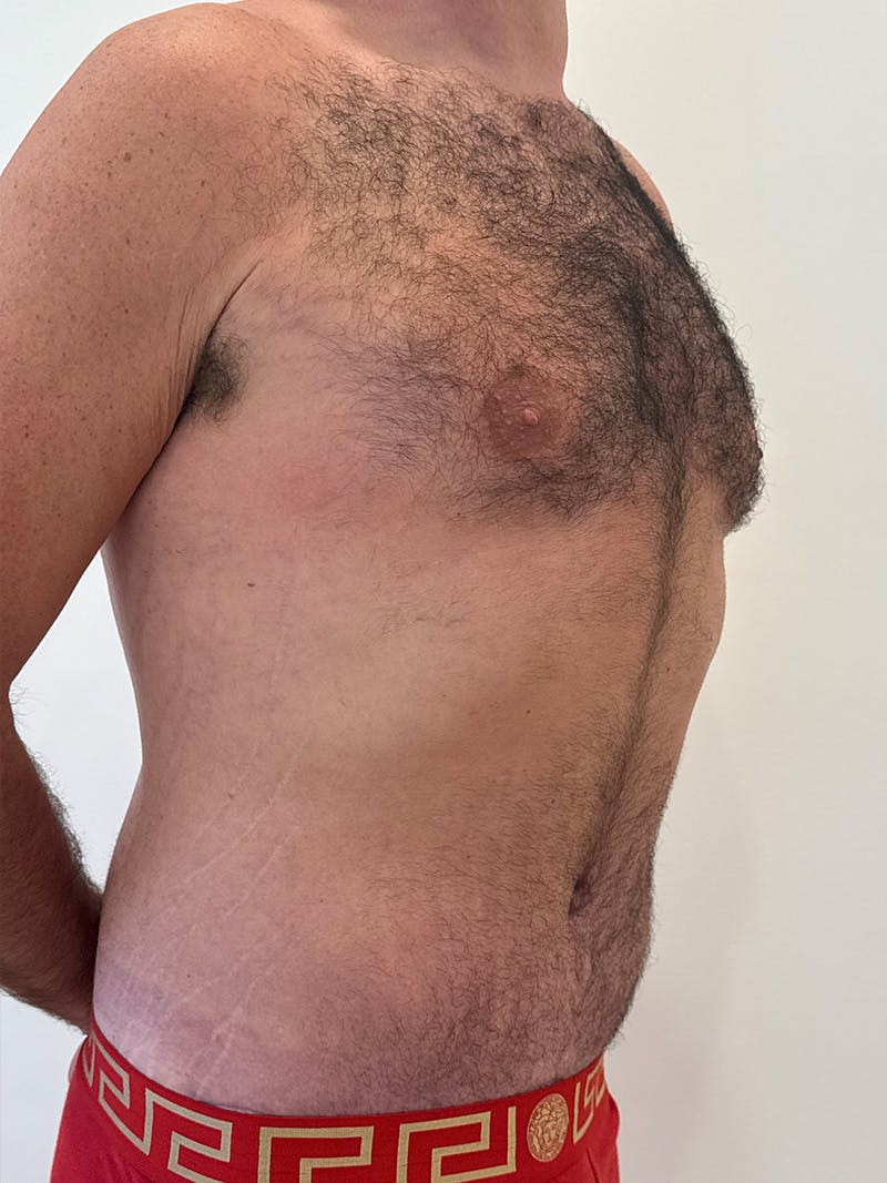 Body Lift Before & After Gallery - Patient 332820 - Image 4