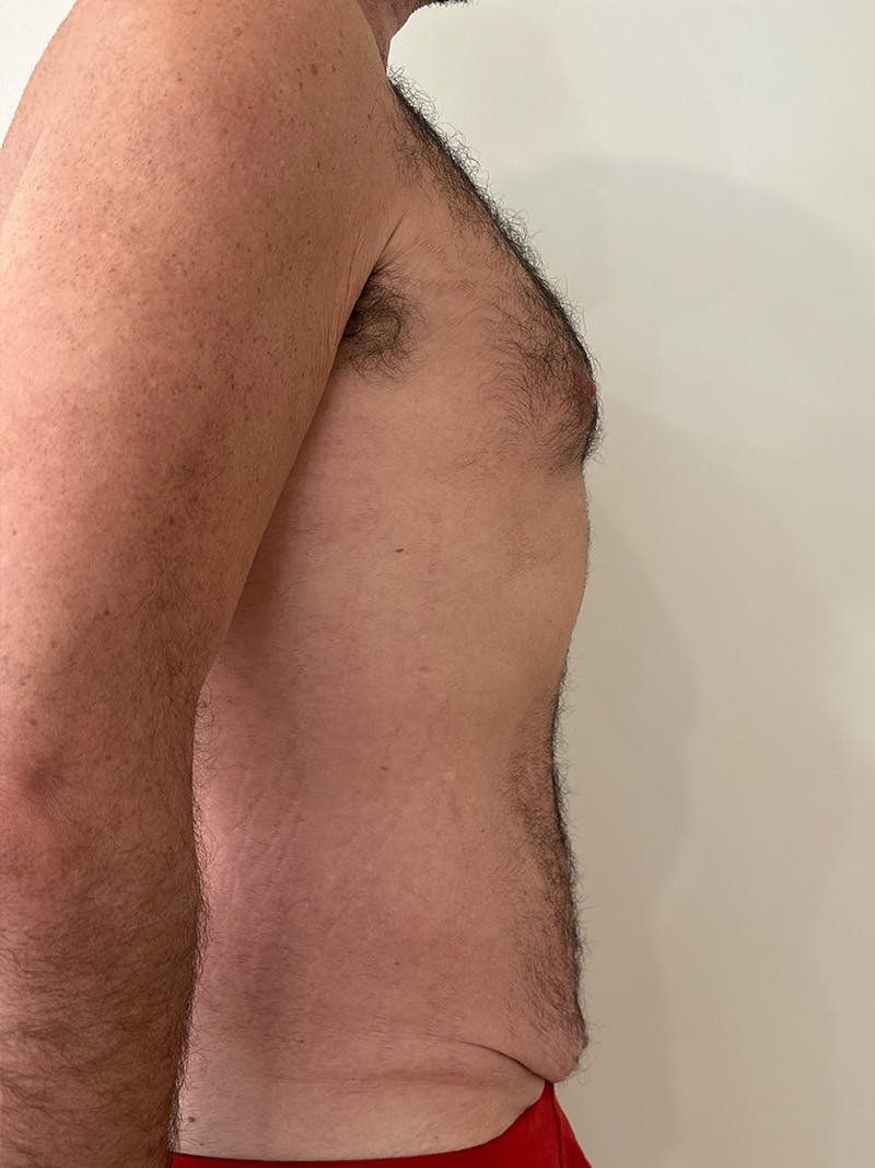 Body Lift Before & After Gallery - Patient 332820 - Image 5