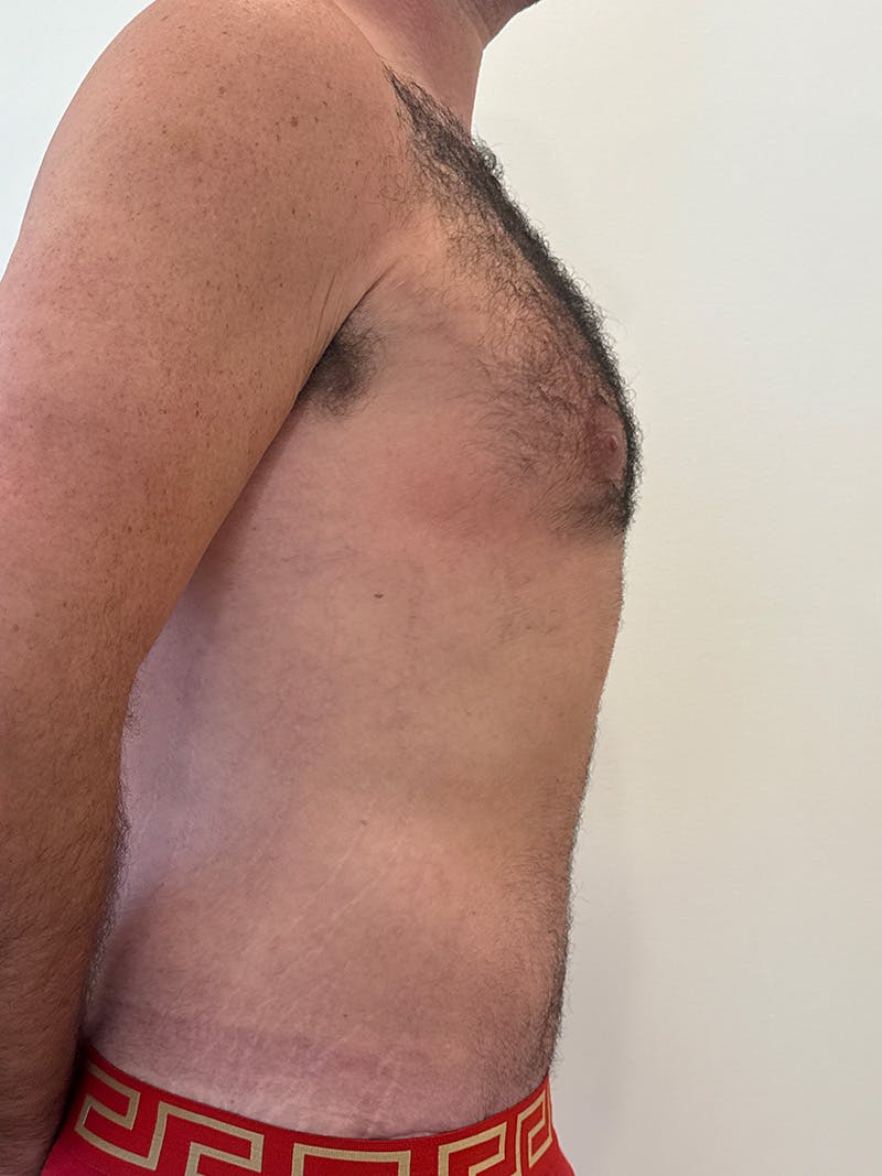 Body Lift Before & After Gallery - Patient 332820 - Image 6