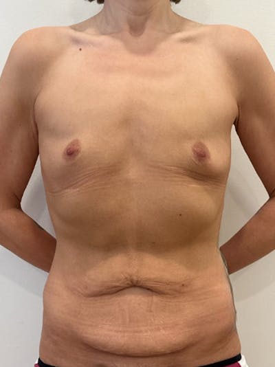 Body Lift Before & After Gallery - Patient 457966 - Image 1