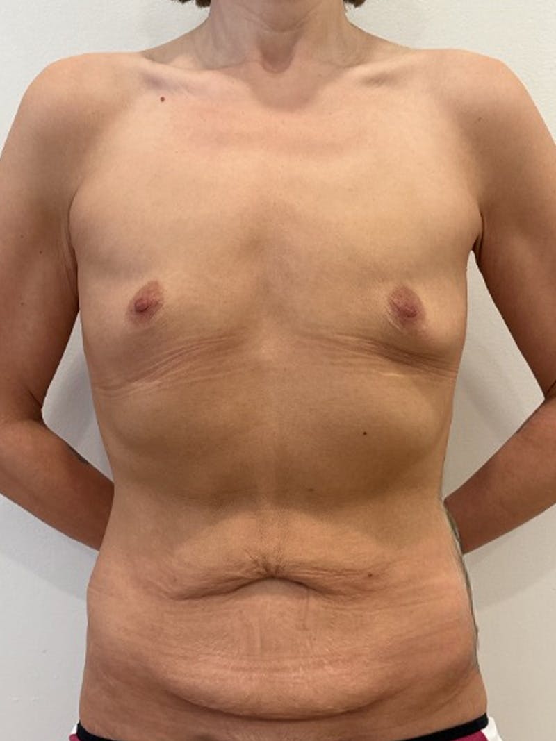 Body Lift Before & After Gallery - Patient 457966 - Image 1