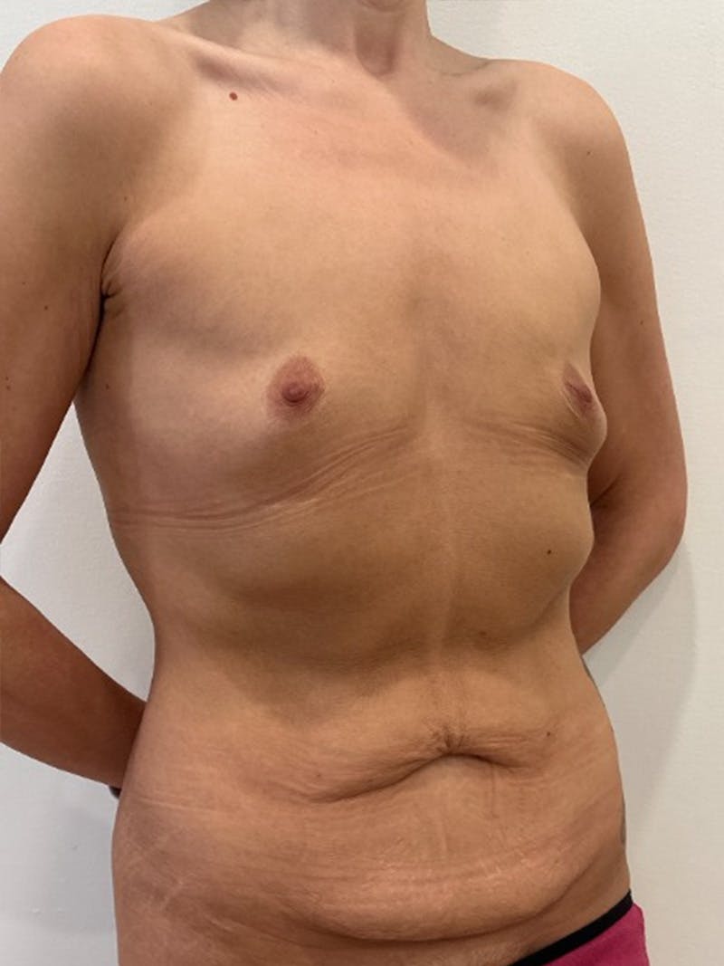 Body Lift Before & After Gallery - Patient 457966 - Image 3