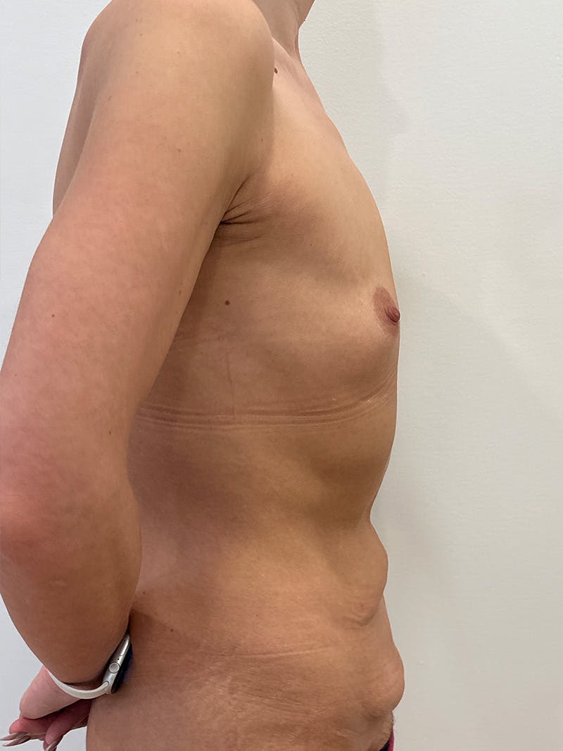 Body Lift Before & After Gallery - Patient 457966 - Image 5
