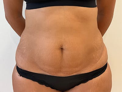 Tummy Tuck Before & After Gallery - Patient 314712 - Image 1
