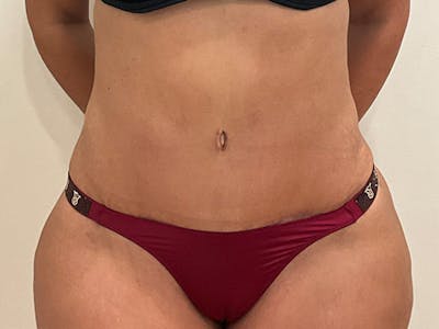Tummy Tuck Before & After Gallery - Patient 314712 - Image 2