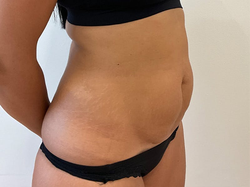 Tummy Tuck Before & After Gallery - Patient 314712 - Image 3