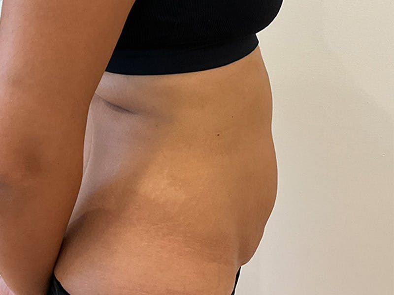 Tummy Tuck Before & After Gallery - Patient 314712 - Image 5