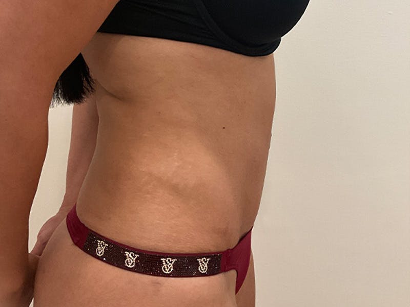 Tummy Tuck Before & After Gallery - Patient 314712 - Image 6