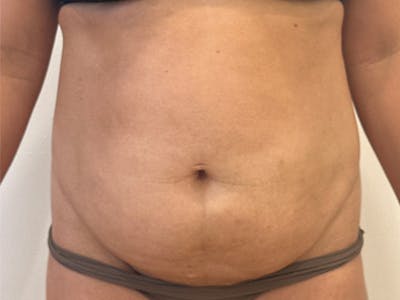 Tummy Tuck Before & After Gallery - Patient 174567 - Image 1