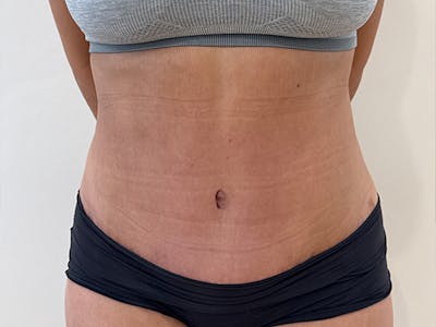 Tummy Tuck Before & After Gallery - Patient 174567 - Image 2