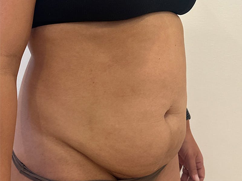 Tummy Tuck Before & After Gallery - Patient 174567 - Image 3