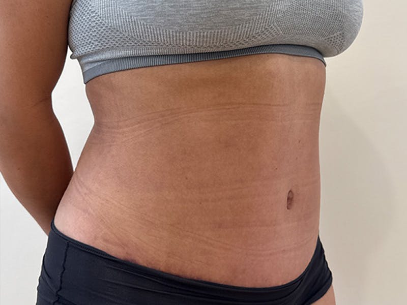 Tummy Tuck Before & After Gallery - Patient 174567 - Image 4