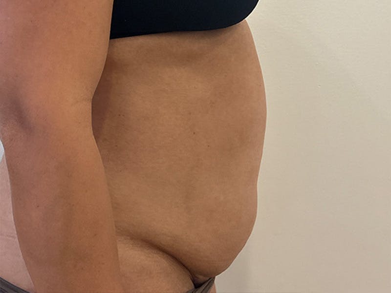 Tummy Tuck Before & After Gallery - Patient 174567 - Image 5