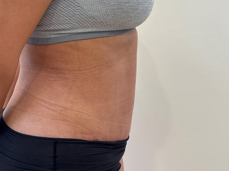 Tummy Tuck Before & After Gallery - Patient 174567 - Image 6
