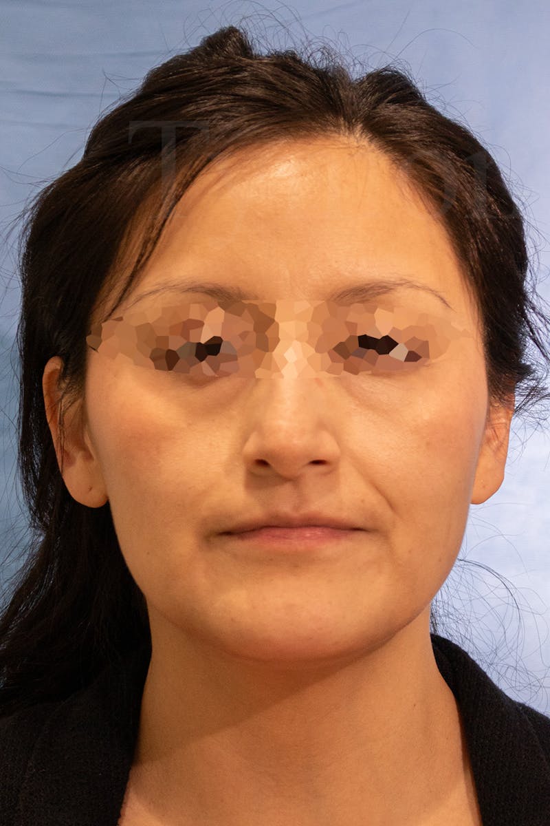 Rhinoplasty Before & After Gallery - Patient 889917 - Image 3