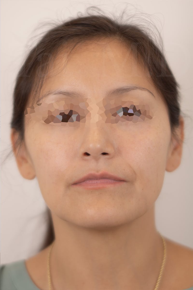 Rhinoplasty Before & After Gallery - Patient 889917 - Image 4