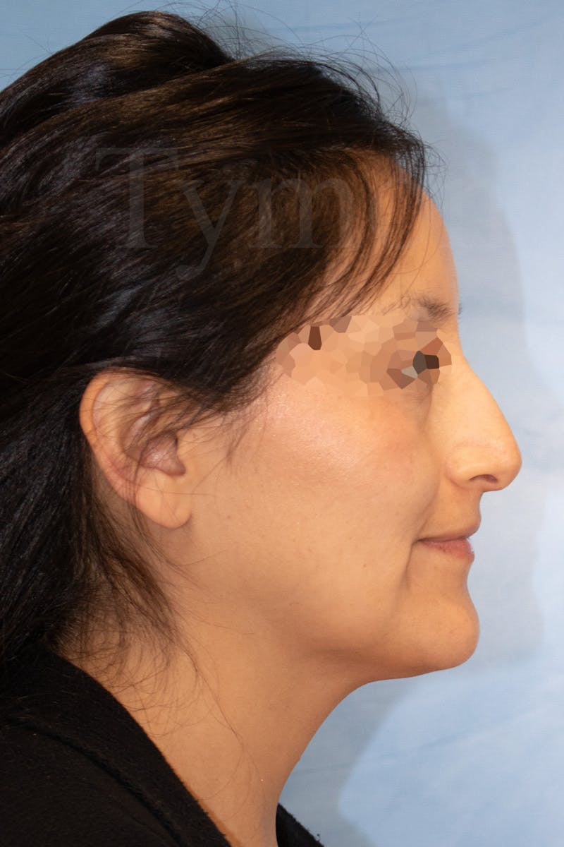 Rhinoplasty Before & After Gallery - Patient 889917 - Image 1