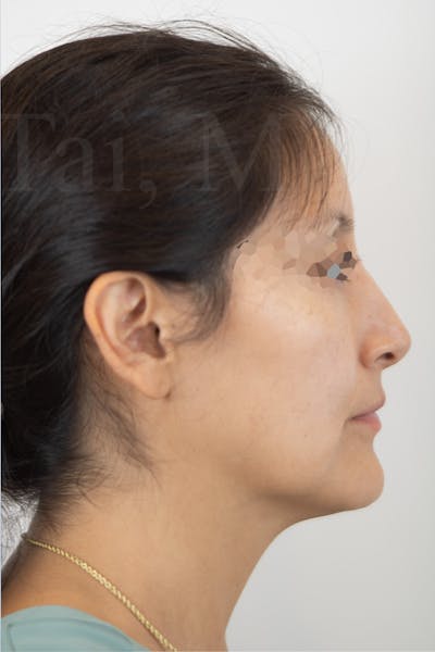 Rhinoplasty Before & After Gallery - Patient 889917 - Image 2