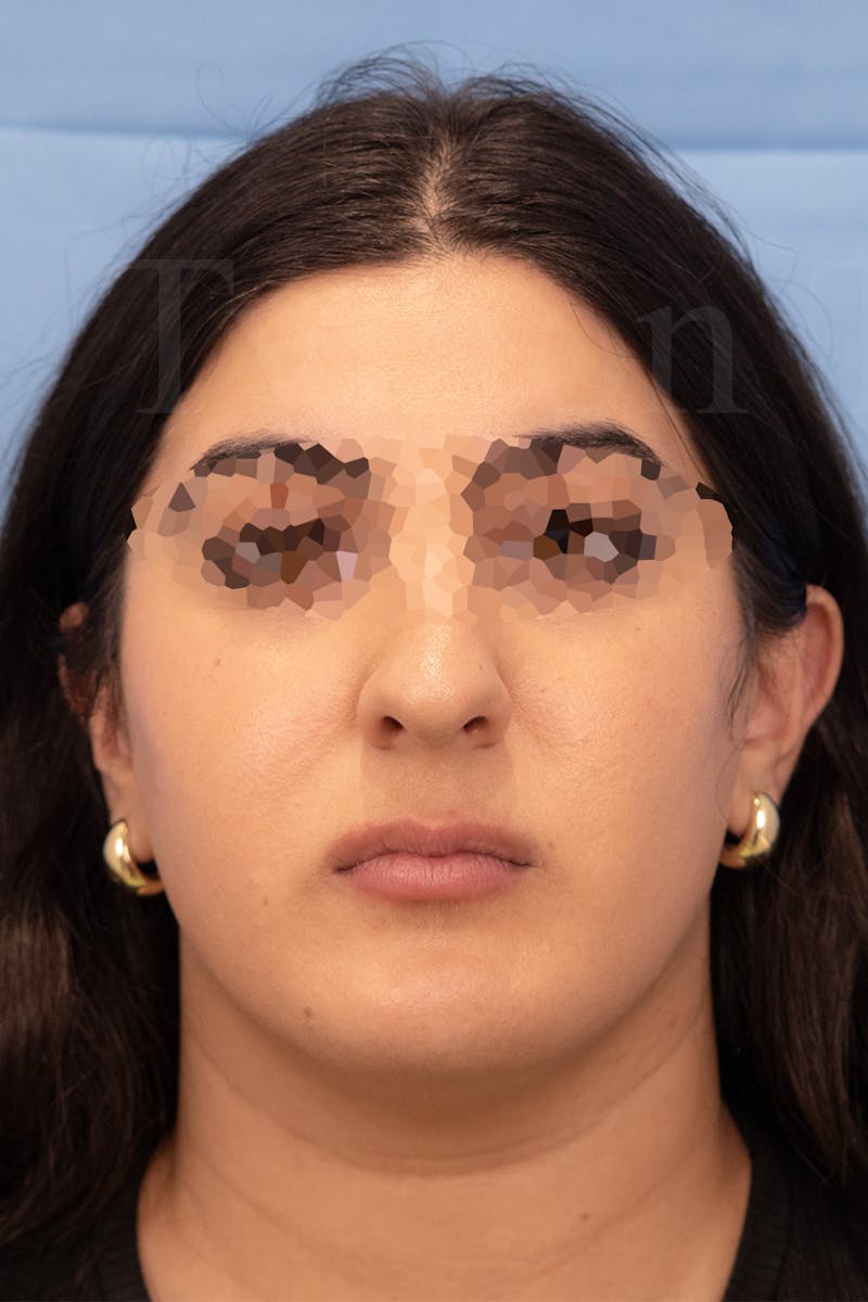 Submental Liposuction Before & After Gallery - Patient 336163 - Image 3