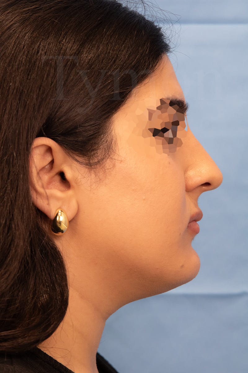 Submental Liposuction Before & After Gallery - Patient 336163 - Image 1