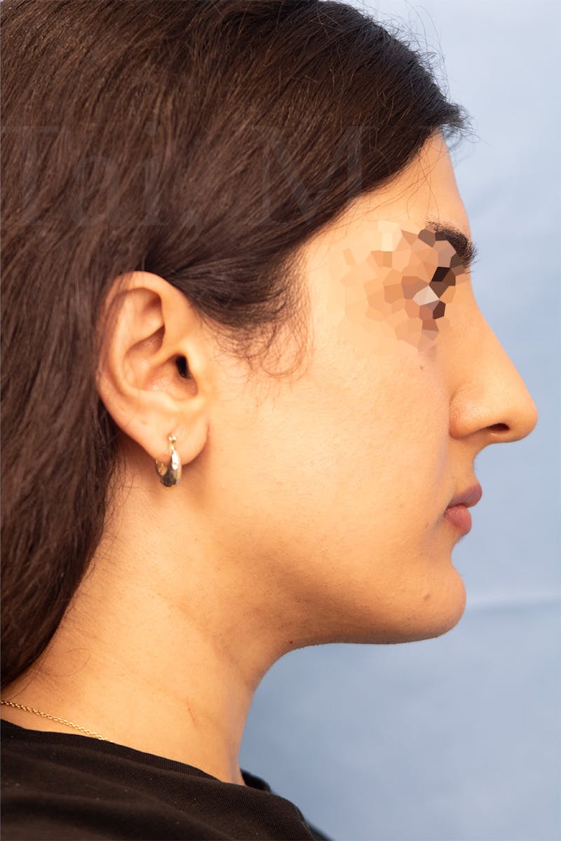 Submental Liposuction Before & After Gallery - Patient 336163 - Image 2