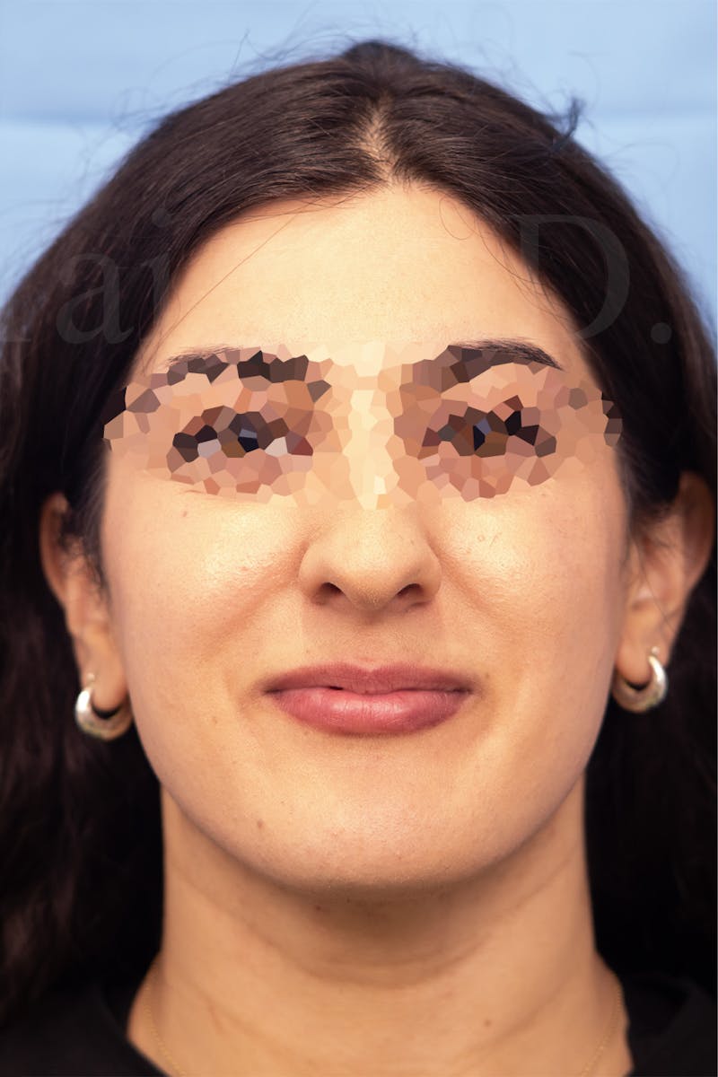 Submental Liposuction Before & After Gallery - Patient 336163 - Image 4