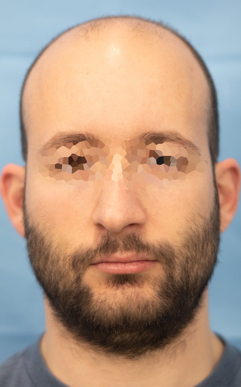 Rhinoplasty Before & After Gallery - Patient 237107 - Image 3