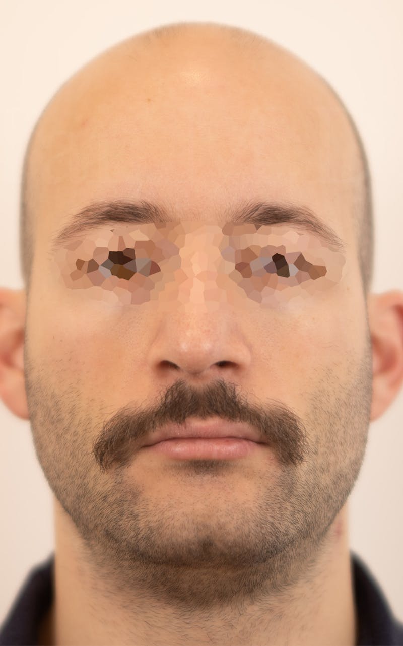 Rhinoplasty Before & After Gallery - Patient 237107 - Image 4