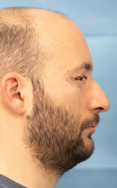 Rhinoplasty Before & After Gallery - Patient 237107 - Image 1