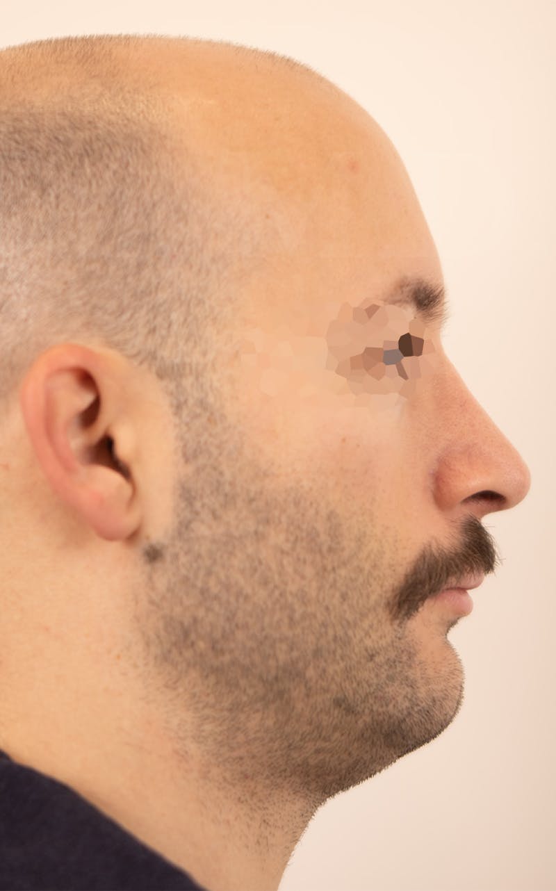 Rhinoplasty Before & After Gallery - Patient 237107 - Image 2