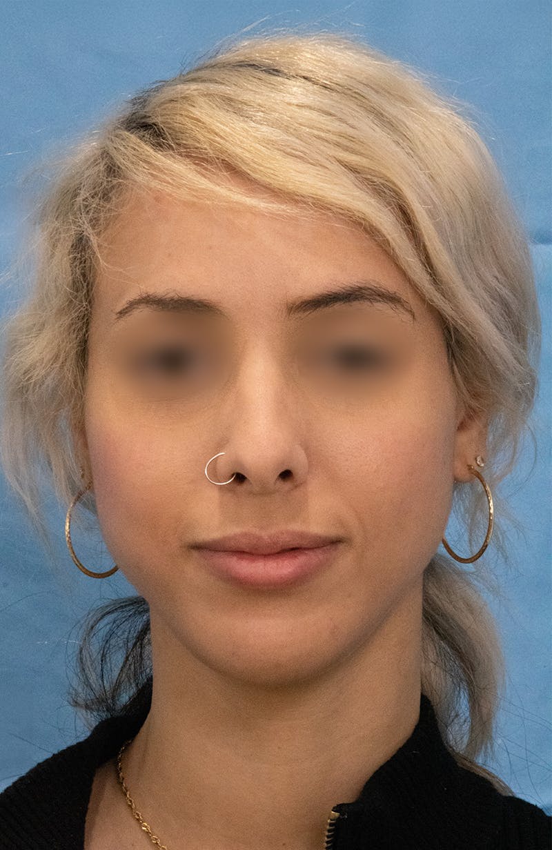 Rhinoplasty Before & After Gallery - Patient 252293 - Image 3