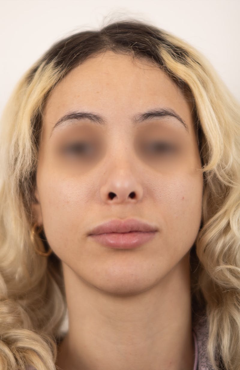 Rhinoplasty Before & After Gallery - Patient 252293 - Image 4