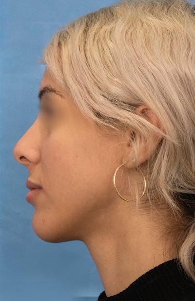 Rhinoplasty Before & After Gallery - Patient 252293 - Image 1