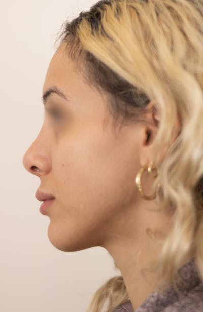 Rhinoplasty Before & After Gallery - Patient 252293 - Image 2