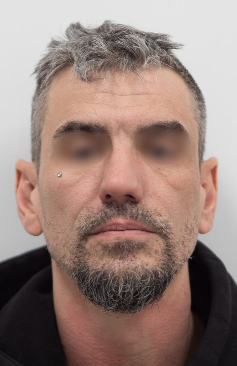 Rhinoplasty Before & After Gallery - Patient 308059 - Image 3