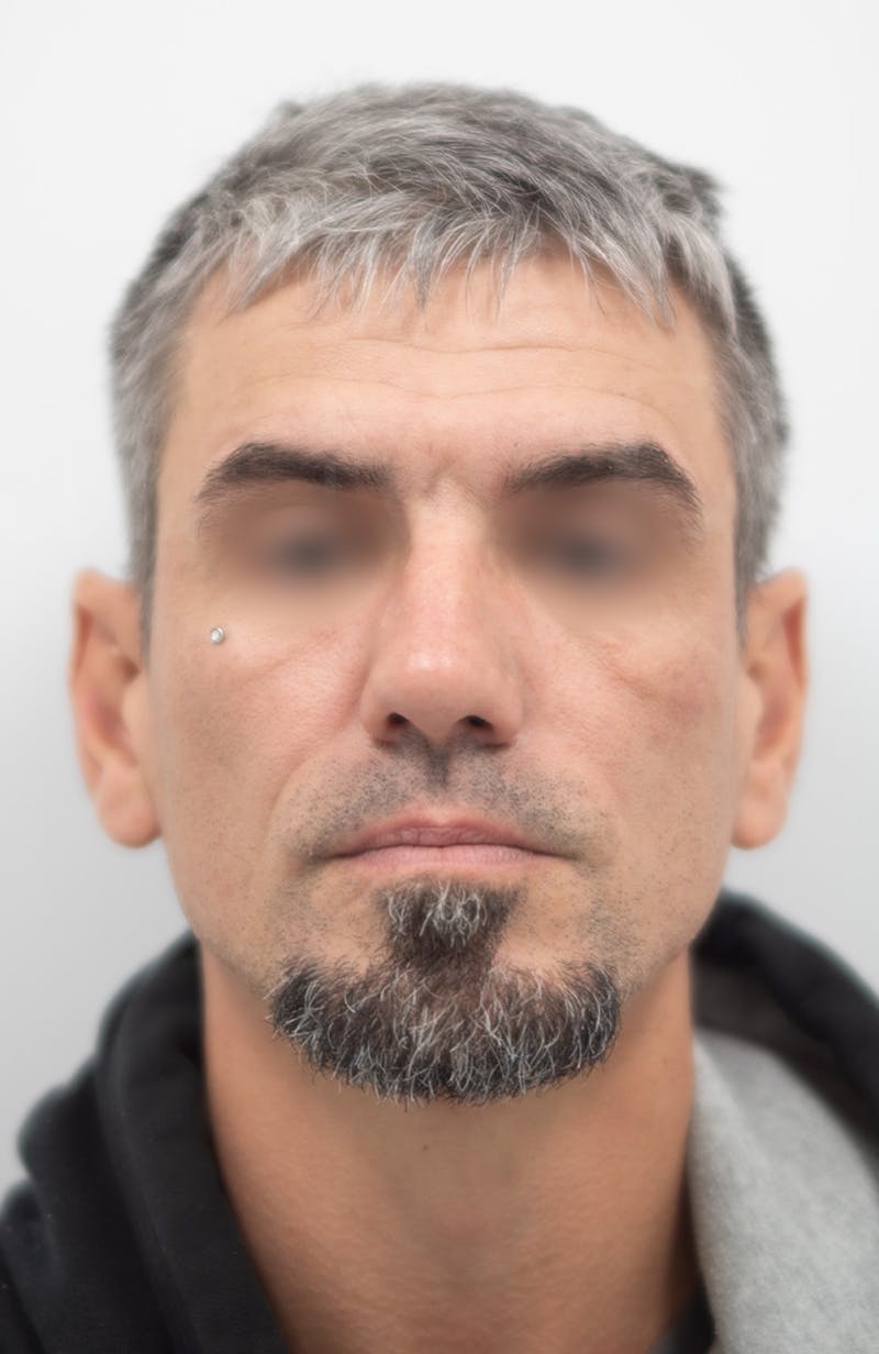 Rhinoplasty Before & After Gallery - Patient 308059 - Image 4