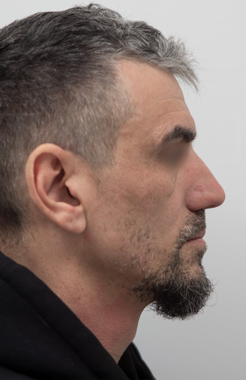 Rhinoplasty Before & After Gallery - Patient 308059 - Image 1