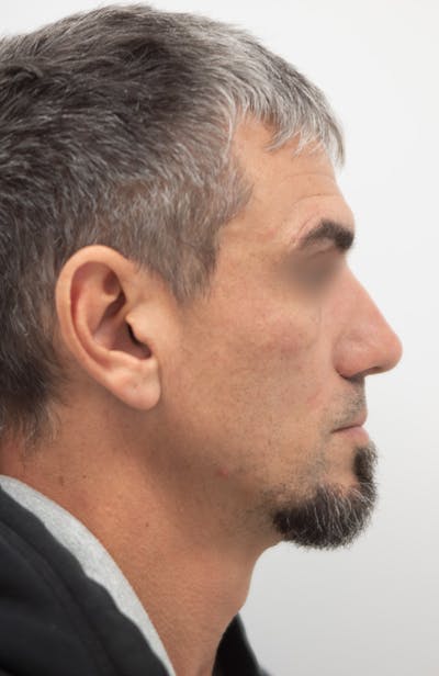 Rhinoplasty Before & After Gallery - Patient 308059 - Image 2