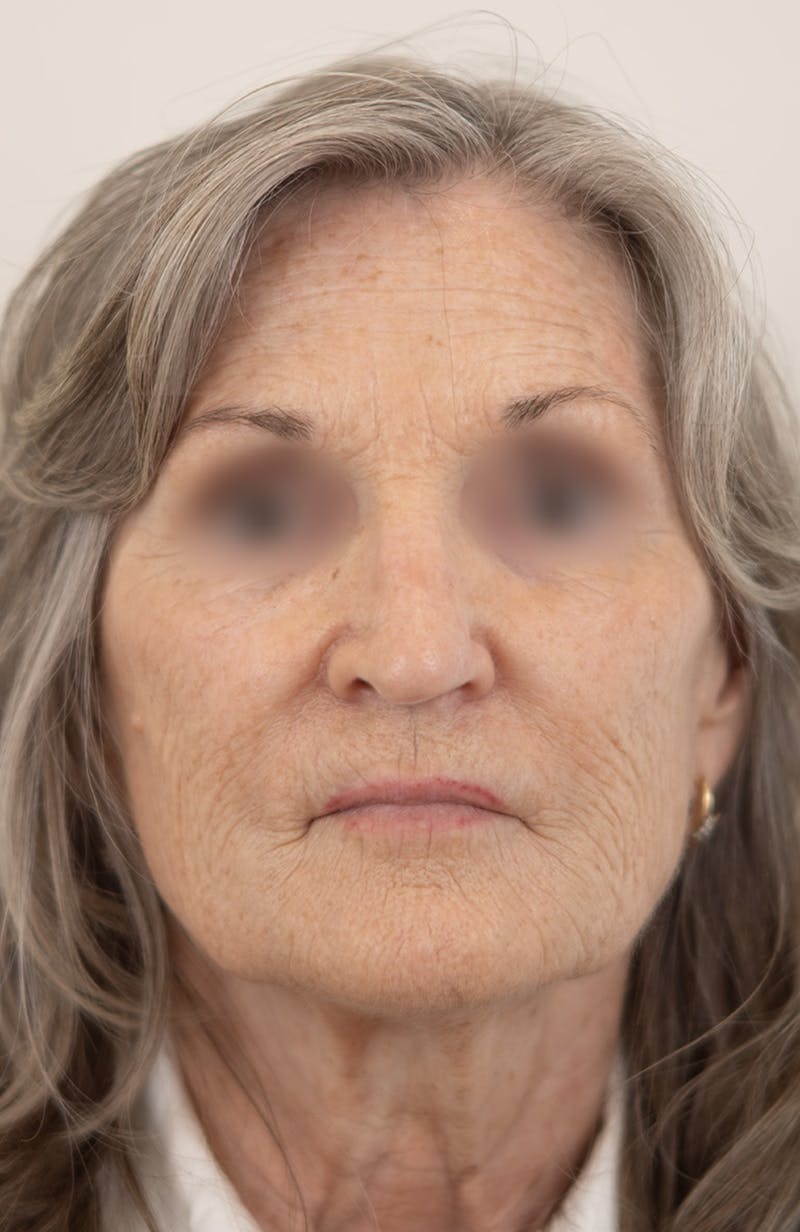 Rhinoplasty Before & After Gallery - Patient 128530 - Image 3