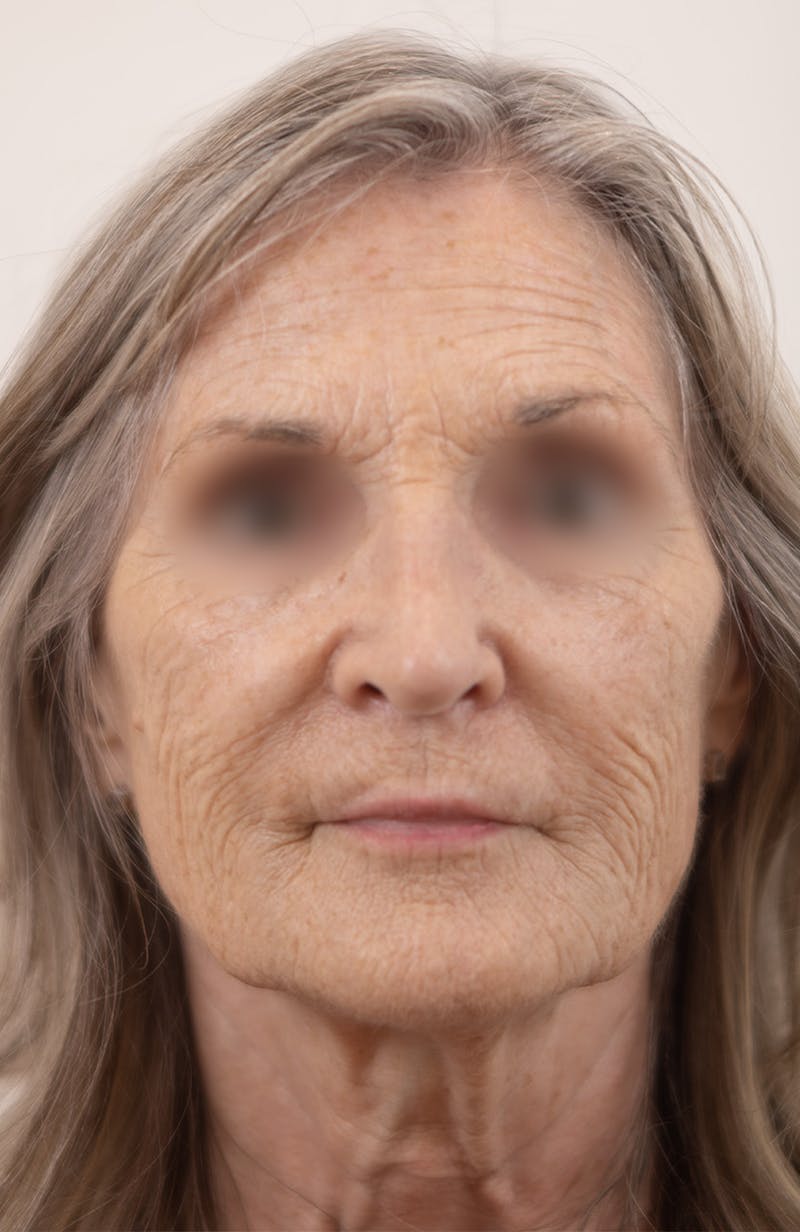 Rhinoplasty Before & After Gallery - Patient 128530 - Image 4