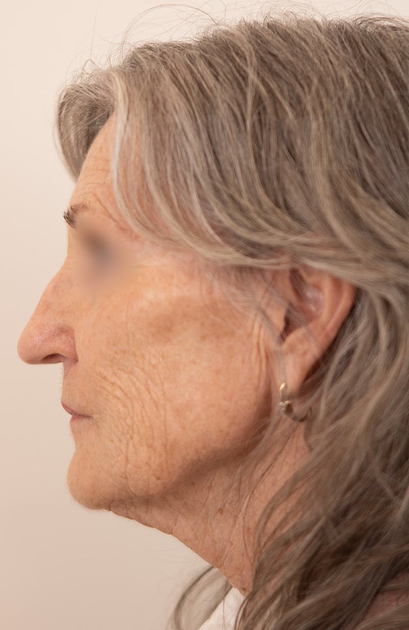 Rhinoplasty Before & After Gallery - Patient 128530 - Image 1