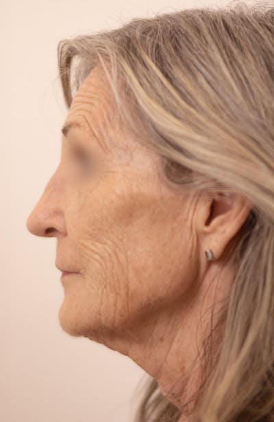 Rhinoplasty Before & After Gallery - Patient 128530 - Image 2