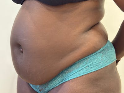 Tummy Tuck Before & After Gallery - Patient 357298 - Image 1