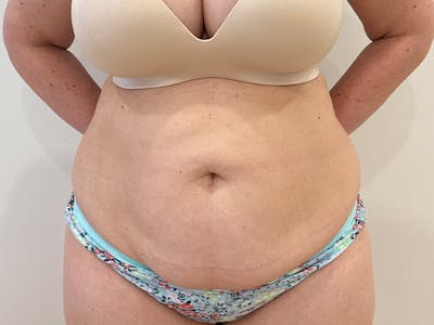 Tummy Tuck Before & After Gallery - Patient 300485 - Image 1