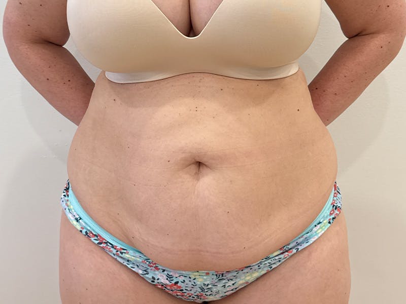 Tummy Tuck Before & After Gallery - Patient 300485 - Image 1