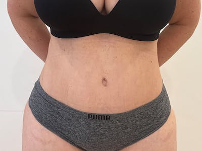 Tummy Tuck Before & After Gallery - Patient 300485 - Image 2