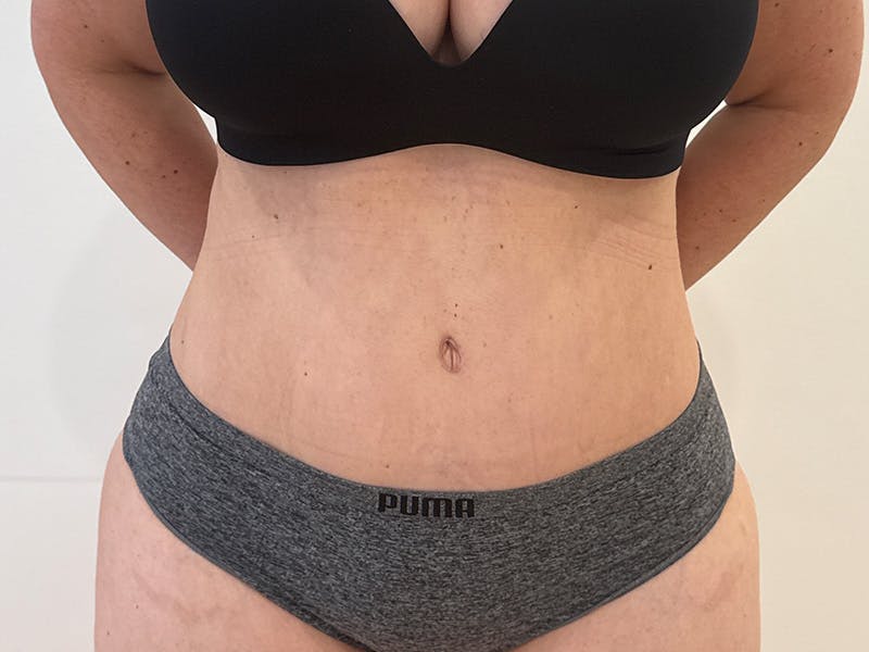 Tummy Tuck Before & After Gallery - Patient 300485 - Image 2