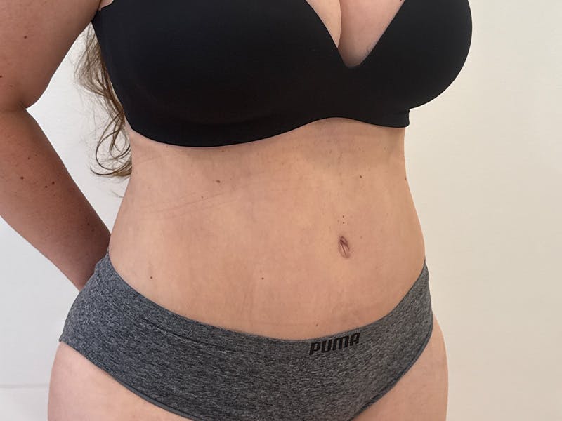Tummy Tuck Before & After Gallery - Patient 300485 - Image 4